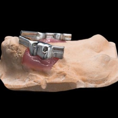 Prótesis dental Madrid