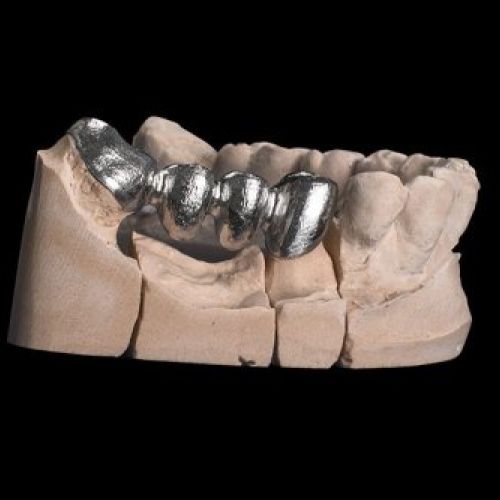 Prótesis dental Madrid