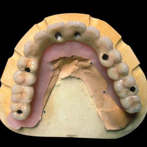 Prótesis dental en Madrid