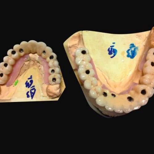 Laboratorio prótesis Madrid