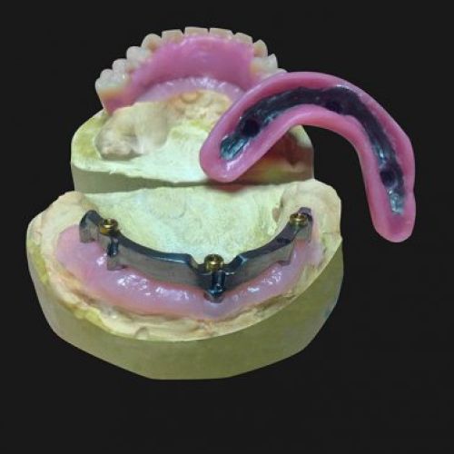 Madrid prótesis dental