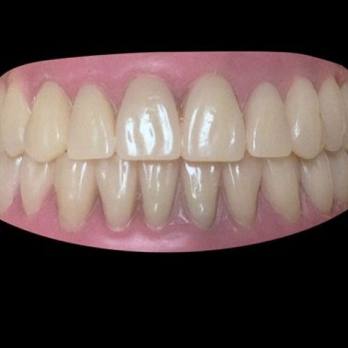 Prótesis dental en Madrid