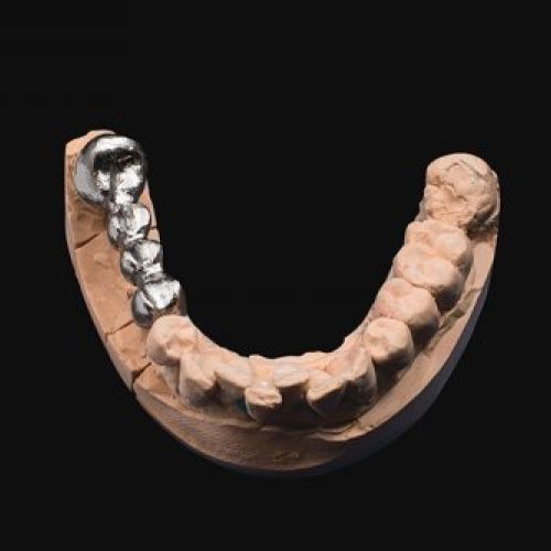 Madrid prótesis dental