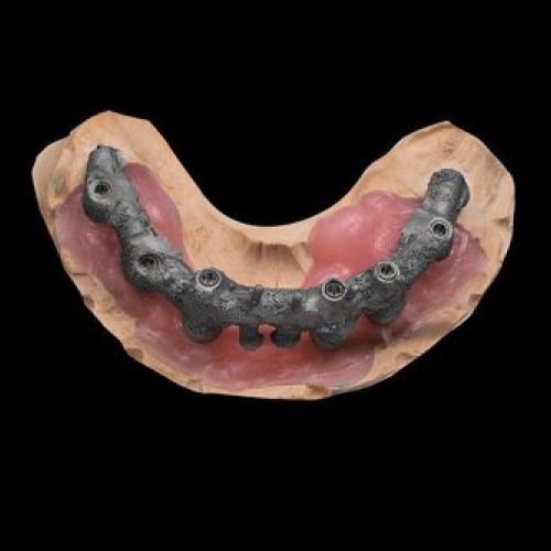 Madrid prótesis dental