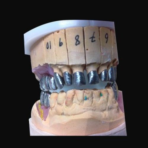 Laboratorio prótesis en Madrid