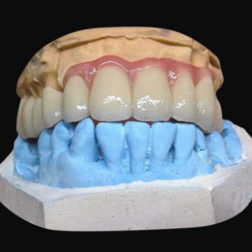 Laboratorio prótesis en Madrid