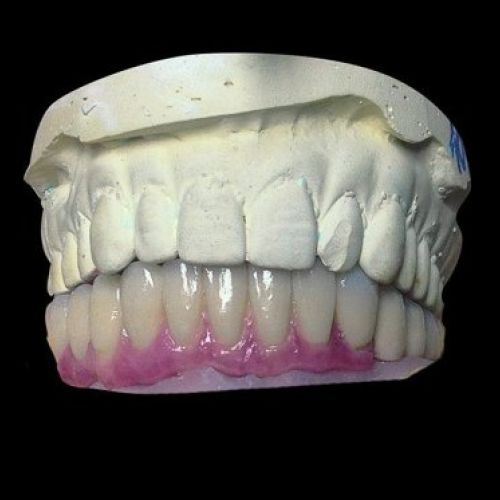 Prótesis dental Madrid