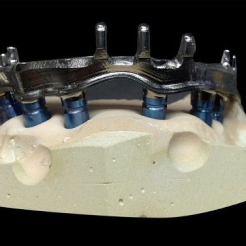 Laboratorio prótesis en Madrid