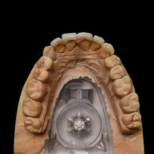 Prótesis dental Madrid