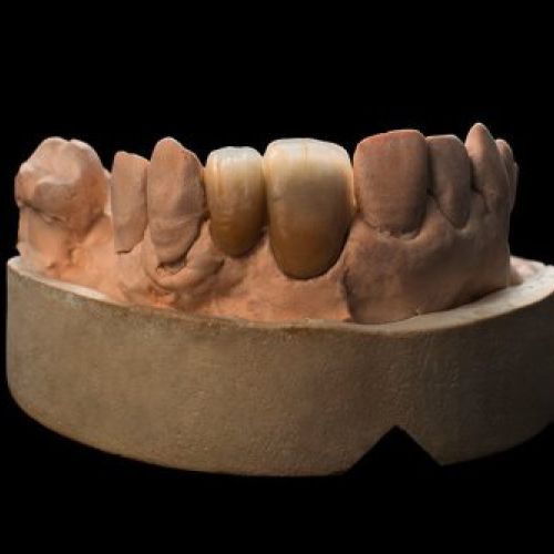 Prótesis dental Madrid