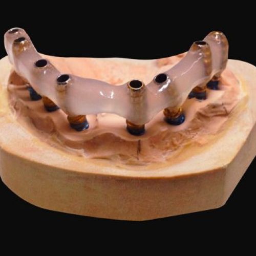 Laboratorio prótesis en Madrid