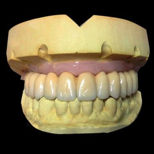 Prótesis dental en Madrid