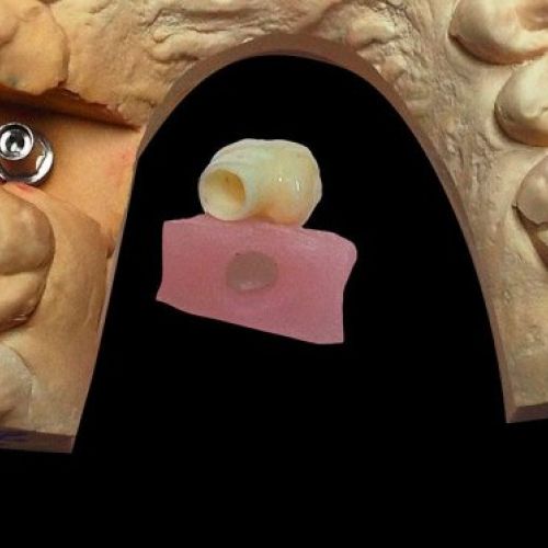 Prótesis dental en Madrid