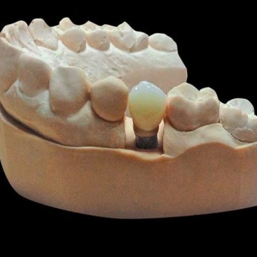 Prótesis dental en Madrid