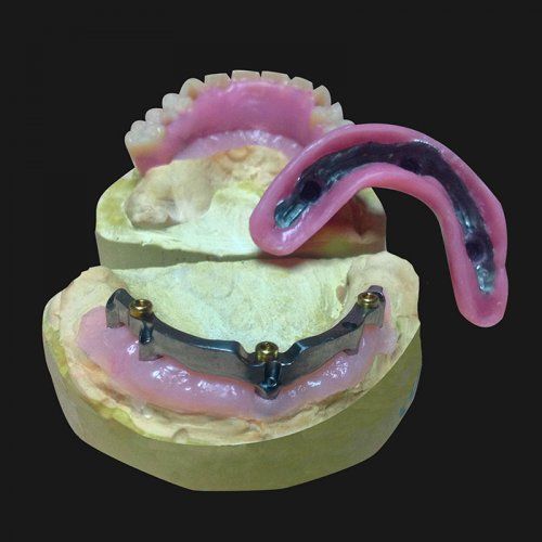 Prótesis sobre implantes